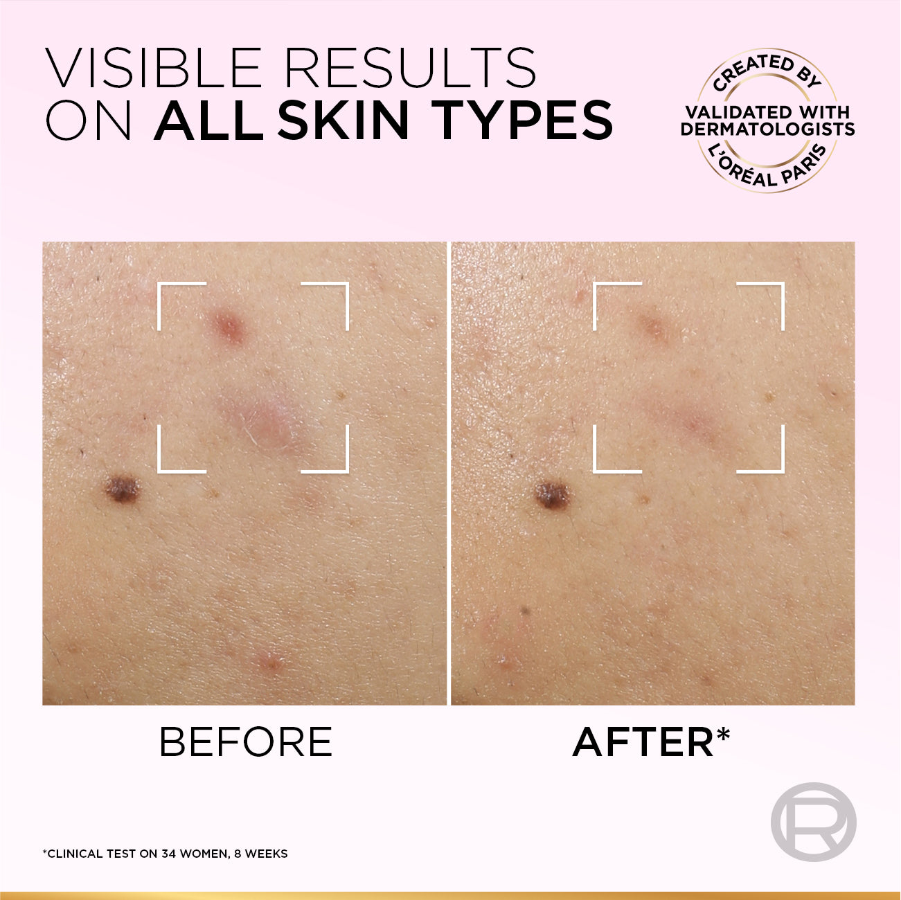 L’Oréal Paris Glycolic Bright Anti-Dark Spot Exfoliant Peel