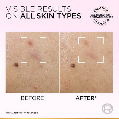 L’Oréal Paris Glycolic Bright Anti-Dark Spot Exfoliant Peel