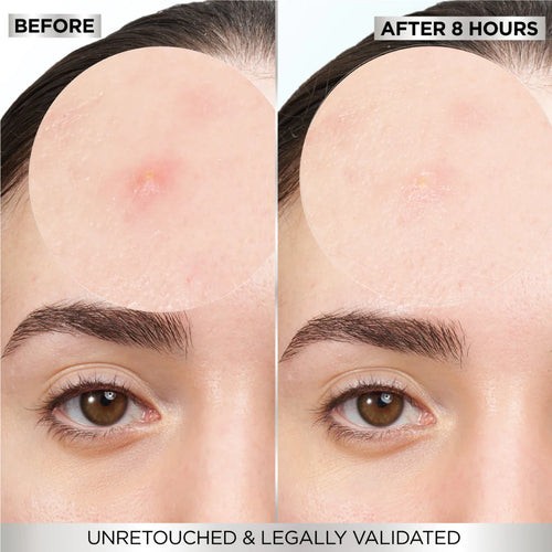 Garnier 8hrs pimple patch