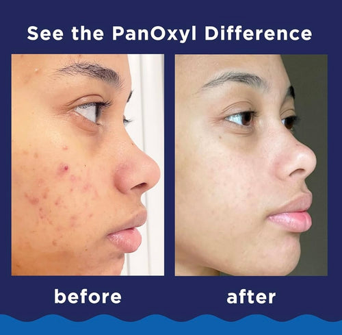PanOxyl Acne creamy Wash 4 %