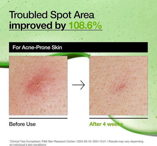 Anua Azelaic Acid 10 Hyaluron Redness Soothing Serum